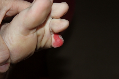 small blister 2.JPG