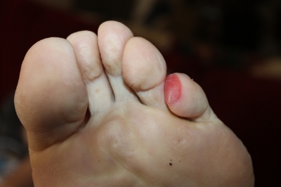 small blister.JPG